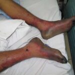 canh-bao-viem-nao-vi-mon-chao-lam-tu-xuong-thit-lon-song-1-min